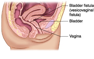 Let Z Urology Help With Your Bladder Fistula