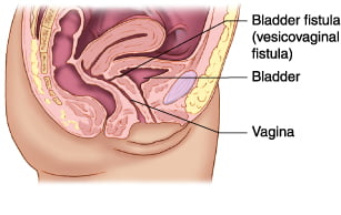 vesicocolic fistula