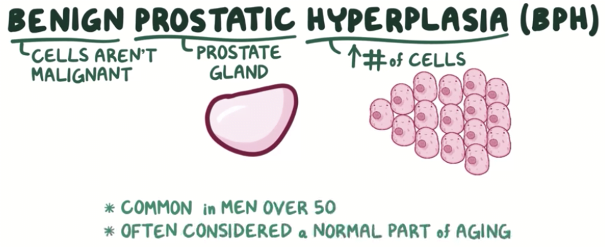 benign prostatic hyperplasia infertility