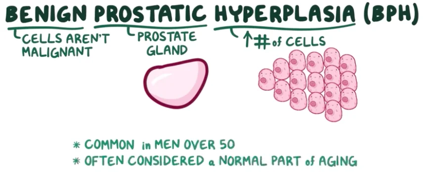 Symptoms & Causes of Benign Prostatic Hyperplasia (BPH)