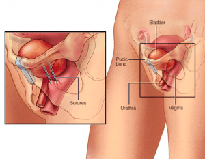 bladder-surgery