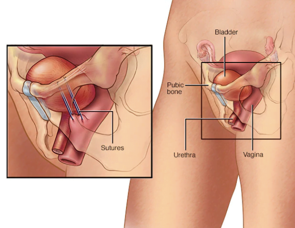 bladder-surgery