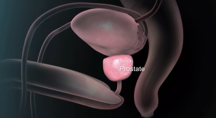 Risk Factors & Complications of Benign Prostatic Hyperplasia (BPH) - Z  Urology