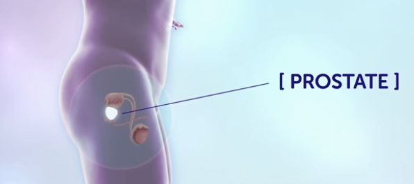 Does Your Prostate Cancer Require Treatment