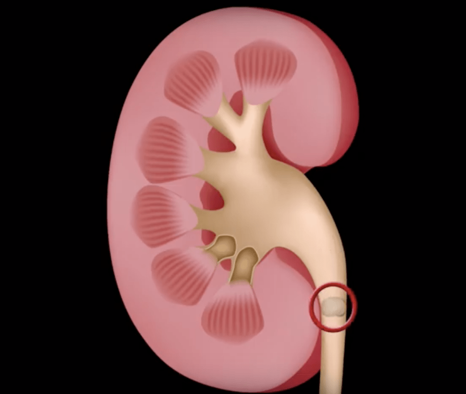 ivcd 10 for hx of kidney stones