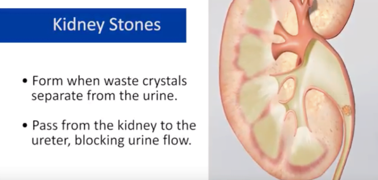 New Treatment Eases the Passage of Kidney Stones - Z Urology