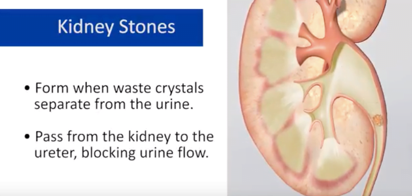 Phimosis - Cure Stone - Urology, Andrology, Renal Transplant