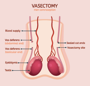 Vasectomy Reversal - Premier Medical Group