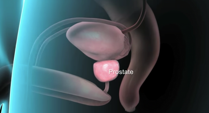 badic kezelés prosztatitis