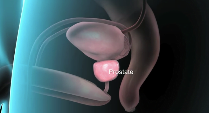 prostata hyperplasia kezelése)