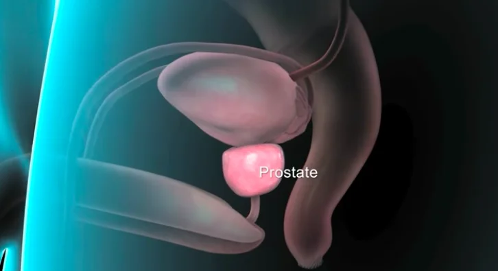 Benign Prostatic Hyperplasia (BPH): 101