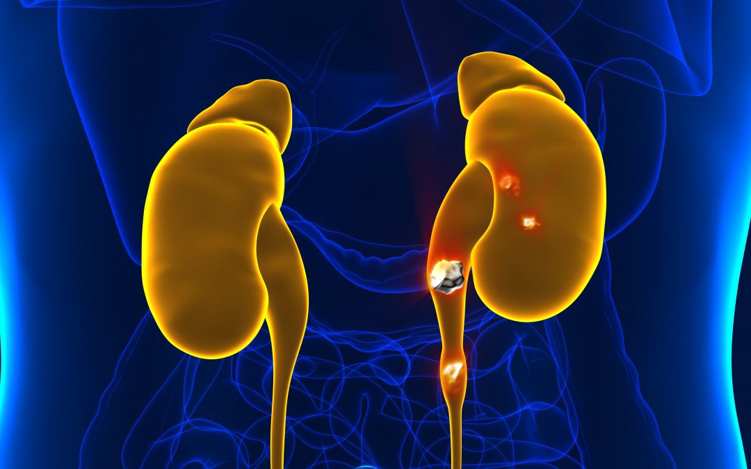 Why Kidney Stones are Such a Pain