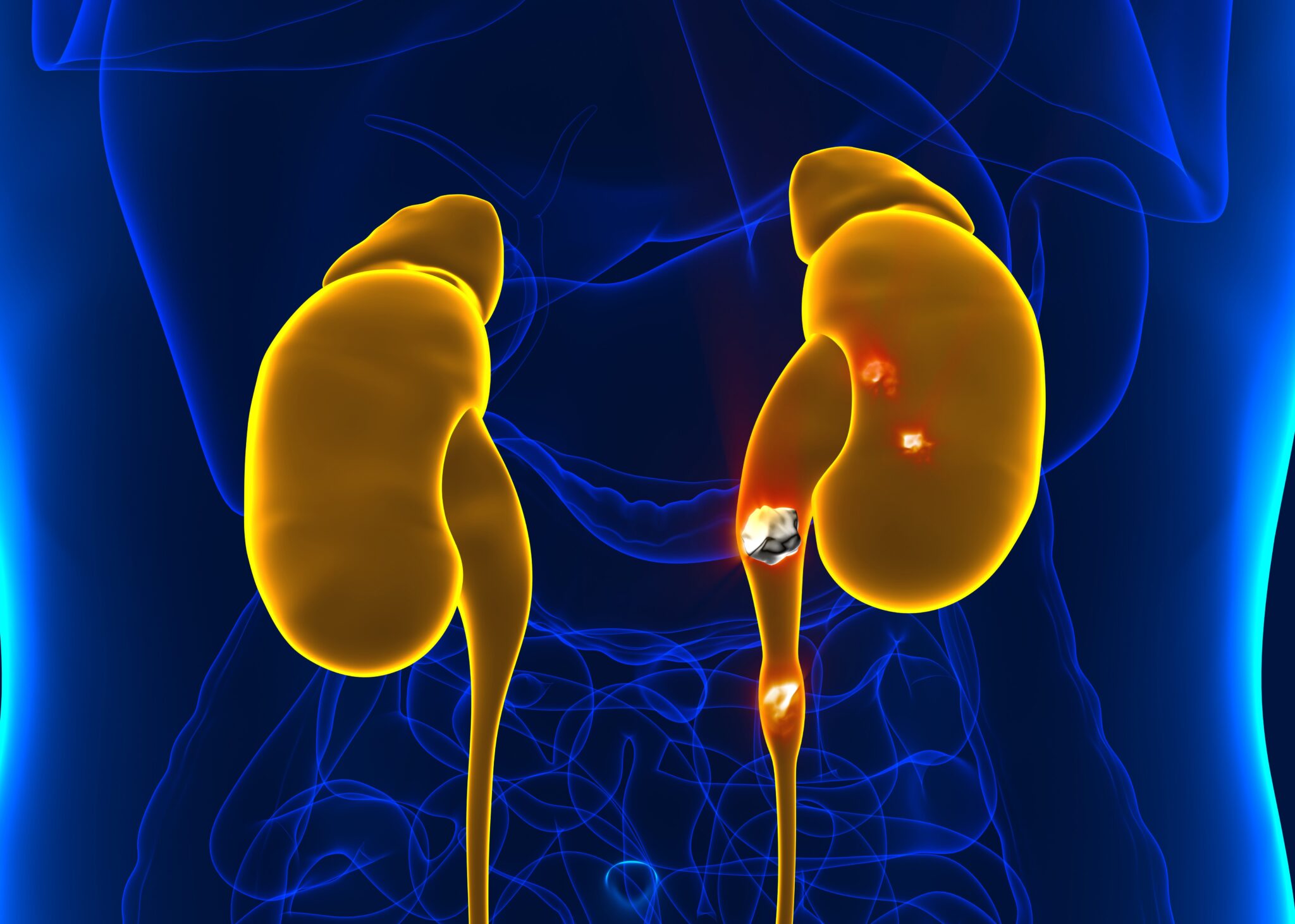 Extracorporeal Shock Wave Lithotripsy ESWL 