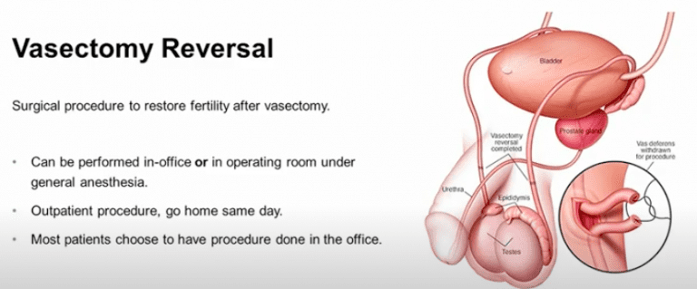 Vasectomy Reversals Just As Successful In Men Over 50 