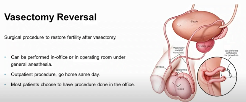 Vasectomy Reversals Just as Successful in Men Over 50 