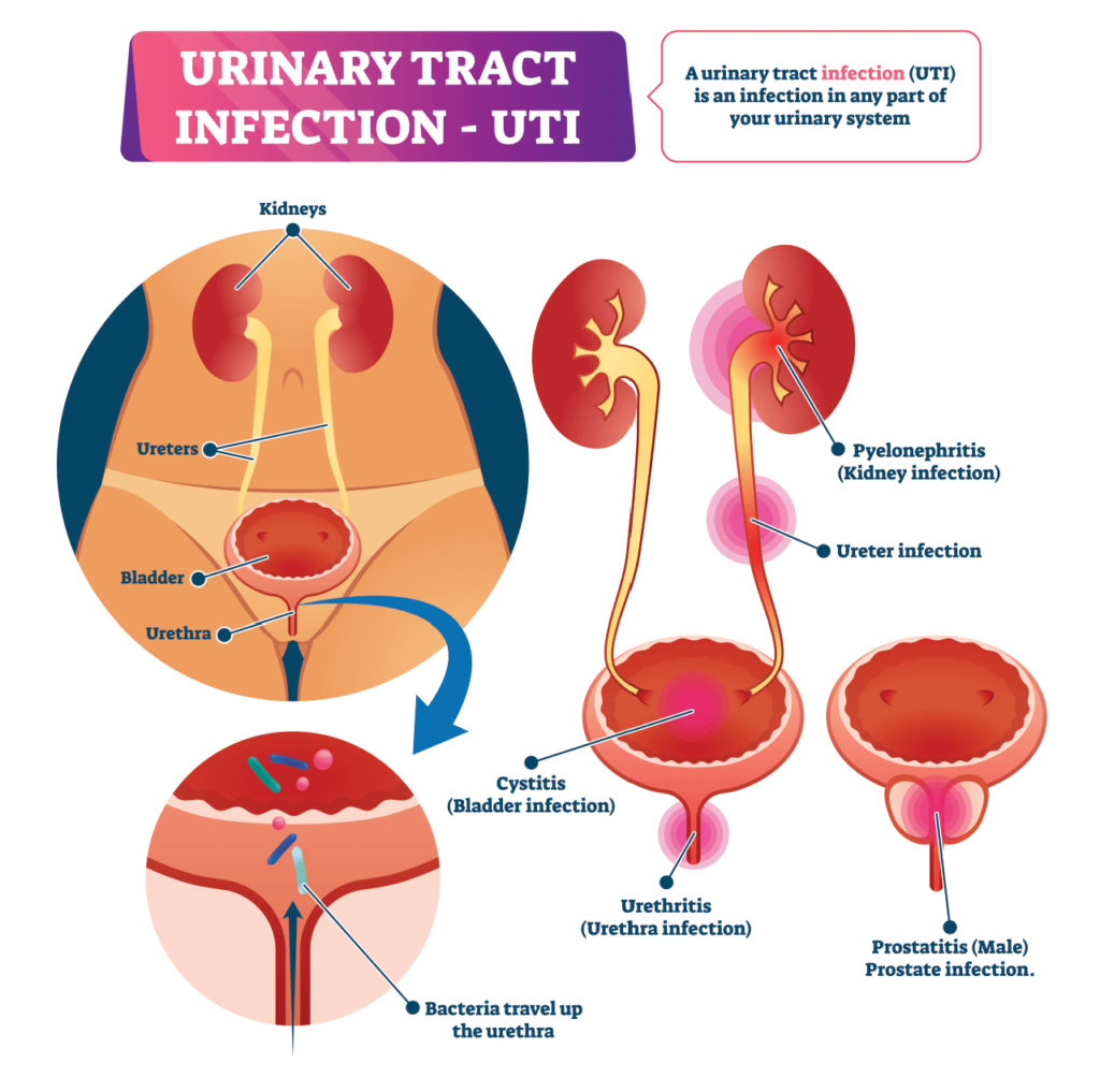 what-happens-when-you-ignore-a-uti-z-urology