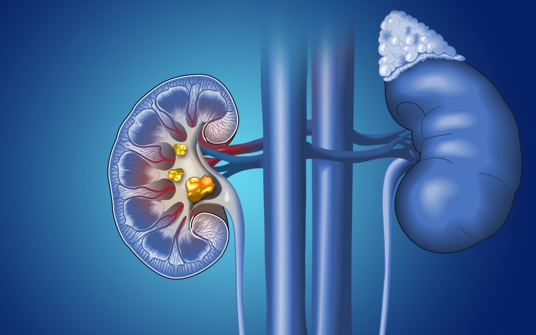 How Laser Lithotripsy Can Treat Patients With Kidney Stones