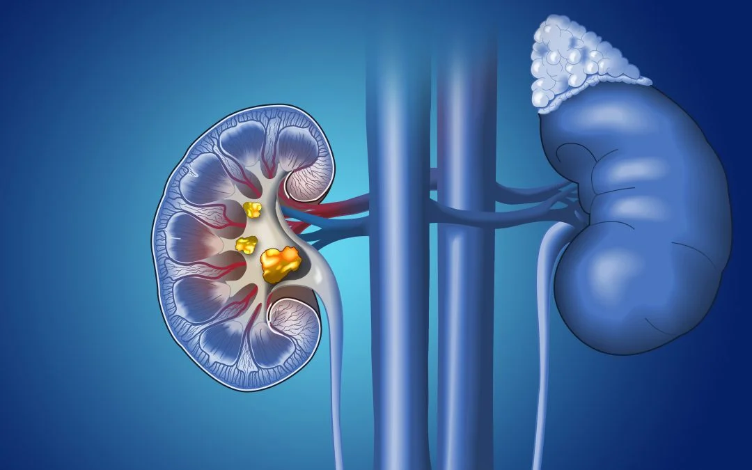 How Laser Lithotripsy Can Treat Patients With Kidney Stones
