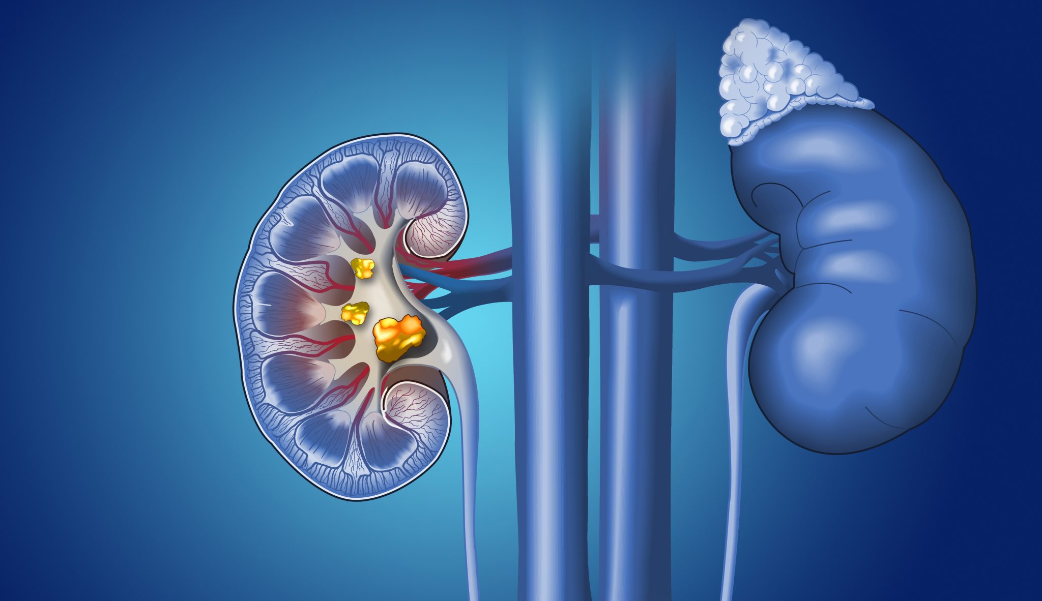 how-laser-lithotripsy-can-treat-patients-with-kidney-stones-z-urology