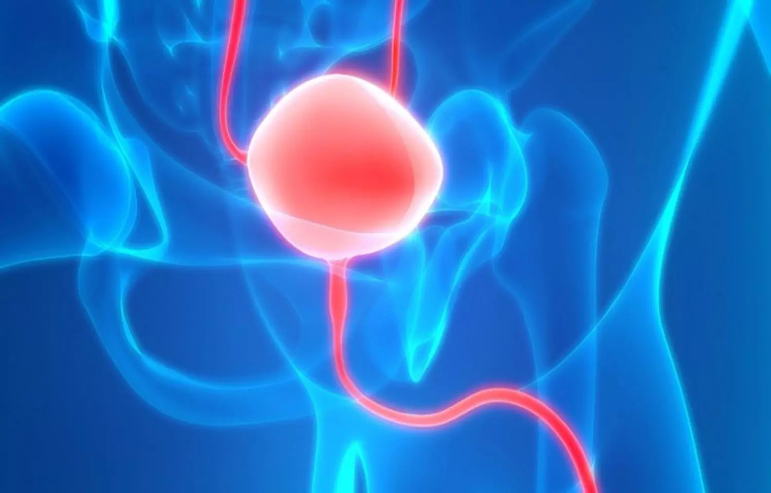 Bladder Stones - Z Urology