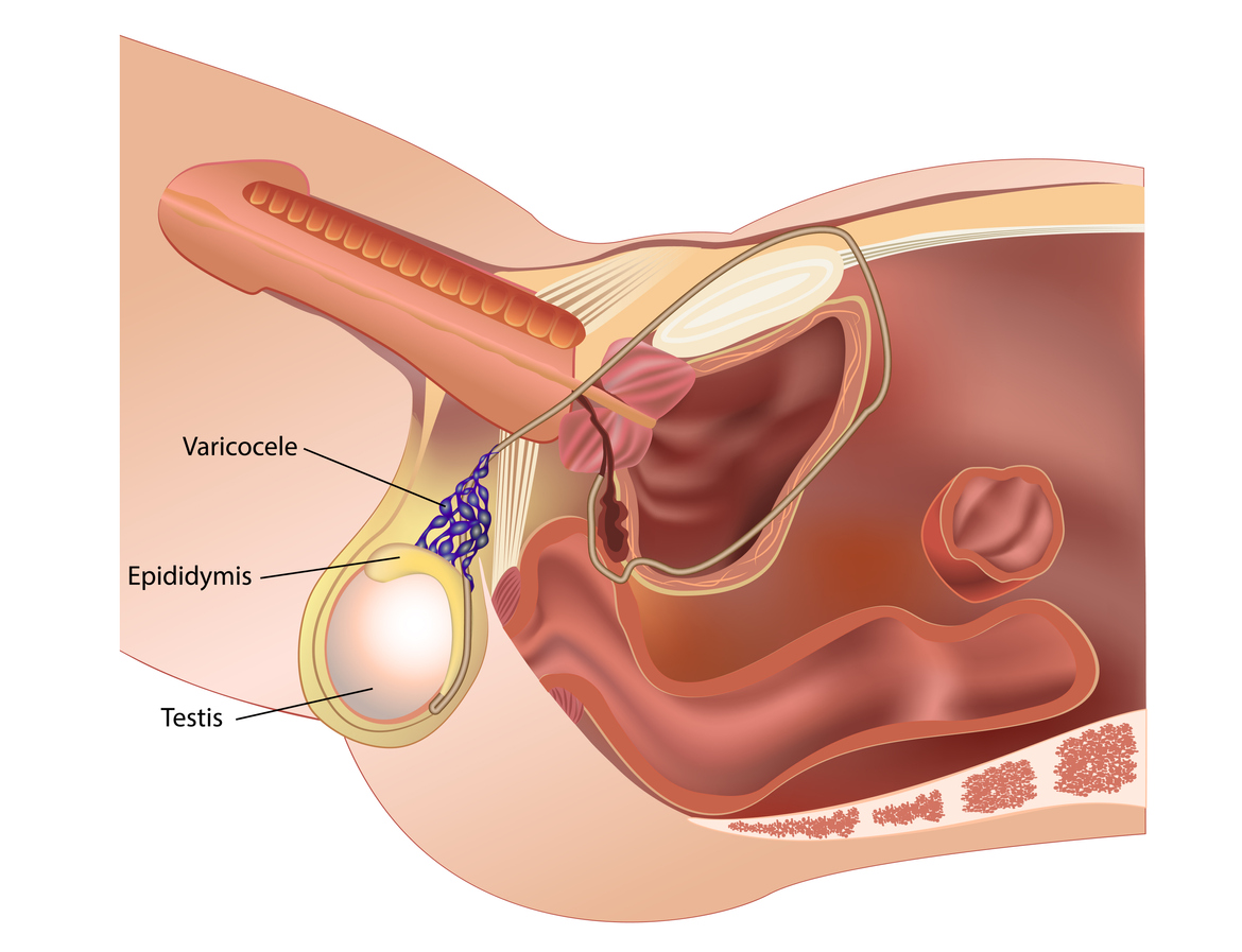 Microsurgical Subinguinal Varicocele Repair. A) Incision sites commonly