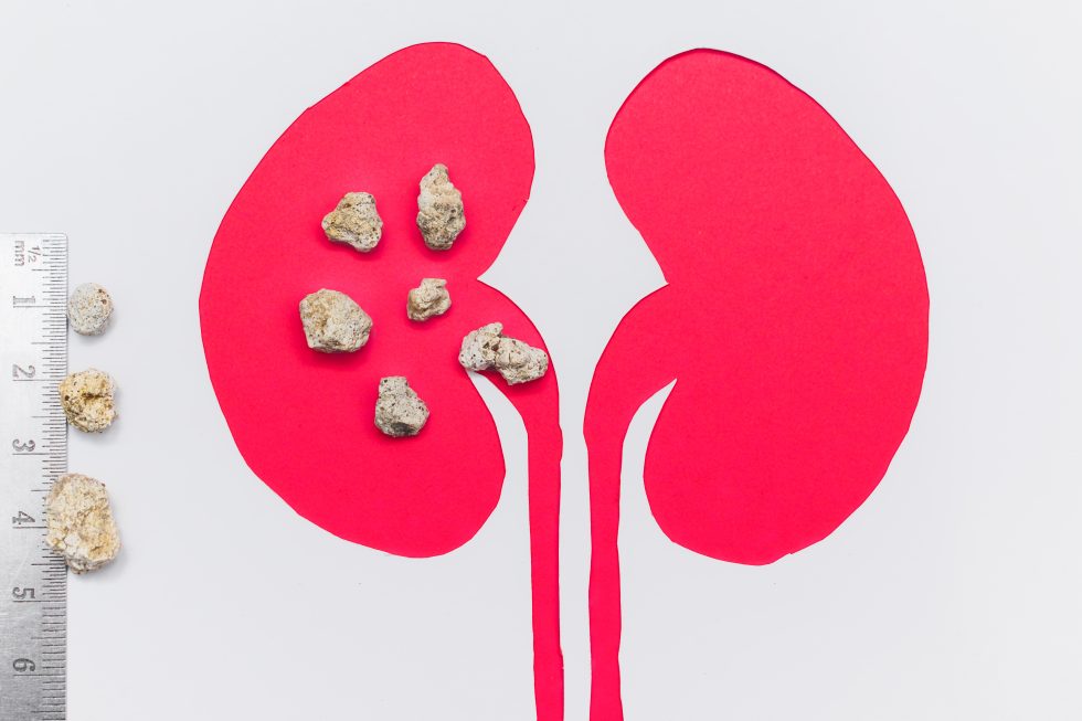 understanding-kidney-stones