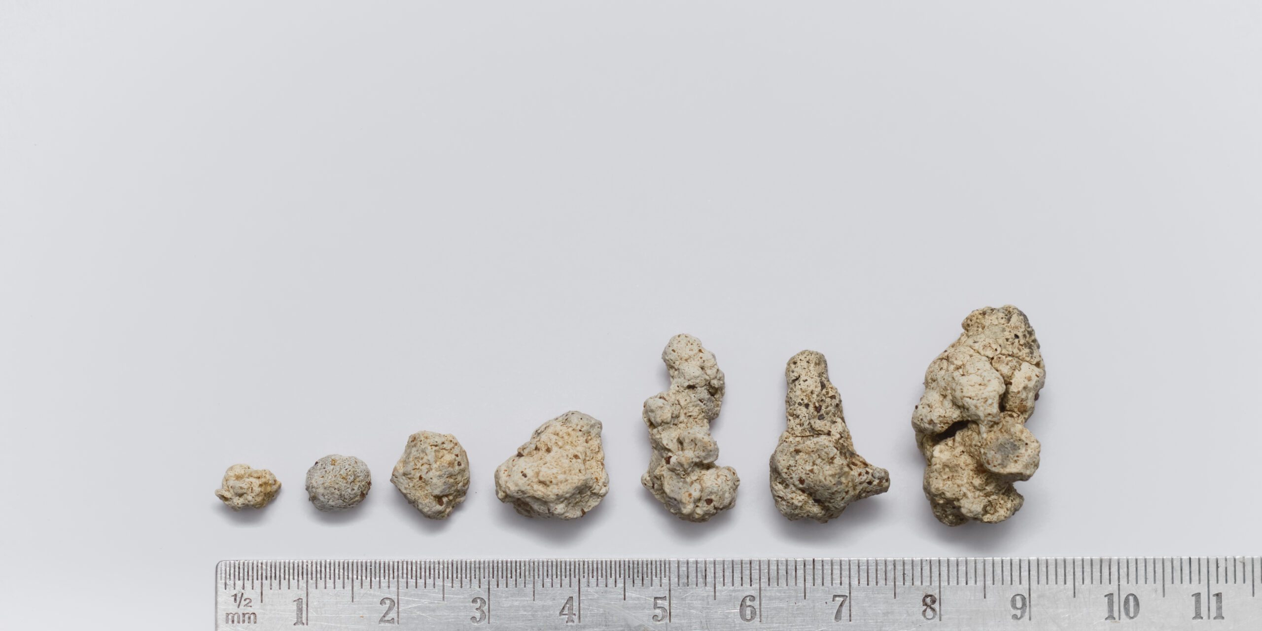 kidney stones, Z Urology