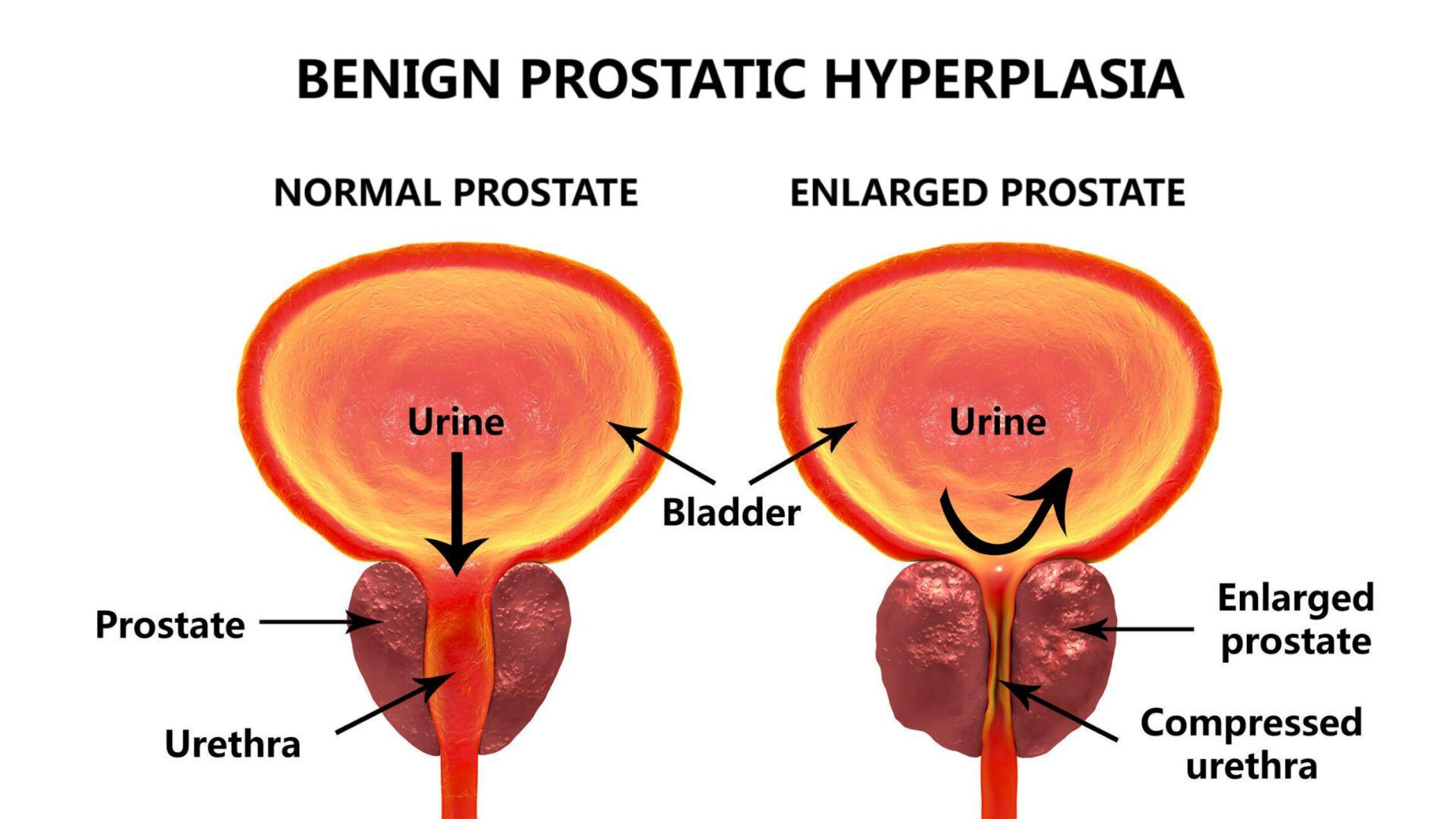 Z Urology's Rezum Procedure Redefining BPH Treatment