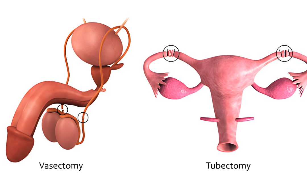 Why More Young Men Are Choosing Vasectomies at Z Urology