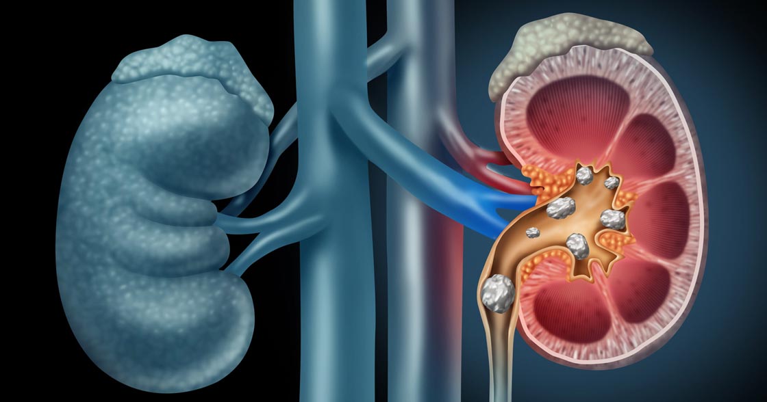 medical drawing of kidney stones in a human kidney