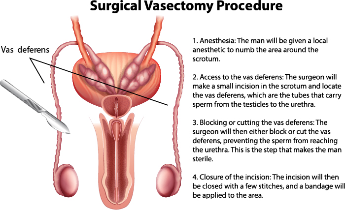 Diagram of male reproductive system showing where a surgeonwould cut the vaas deferens for a vasectomy procedure